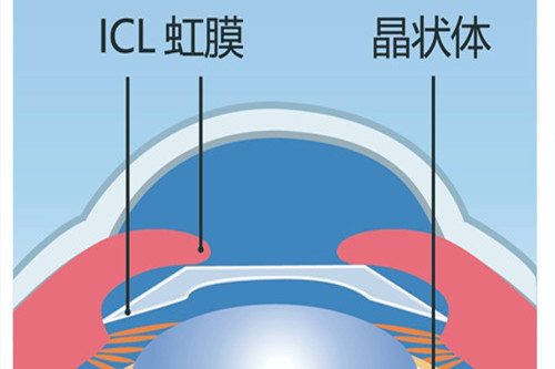 近视晶体植入在哪个部位?为什么说近视晶体植入是可逆的?