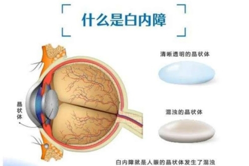 70岁老人做白内障手术要钱吗?白内障免费政策告诉你!