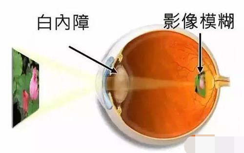 白内障影像示意图