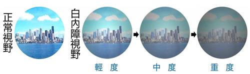 白内障的视野
