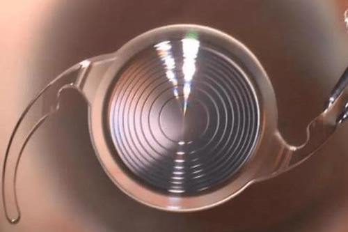 白内障无极变焦晶体展示