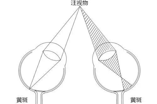正常眼和弱视眼注视物体时眼内成像示意图