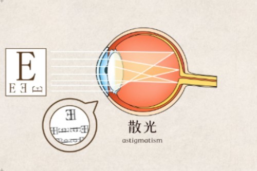 散光不近视需要戴眼镜吗？散光不近视影响征兵体检吗？
