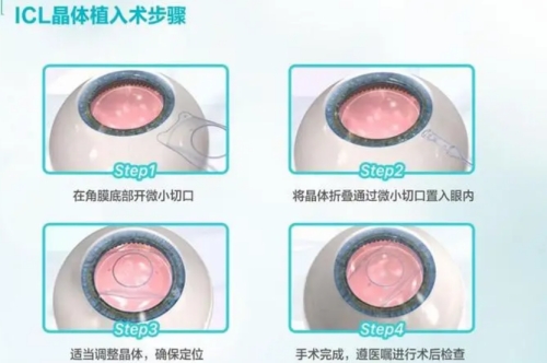  ICL晶体植入步骤图