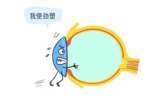 梦戴维角膜塑形镜怎么样？价格/时效/左右眼如何区分文内有