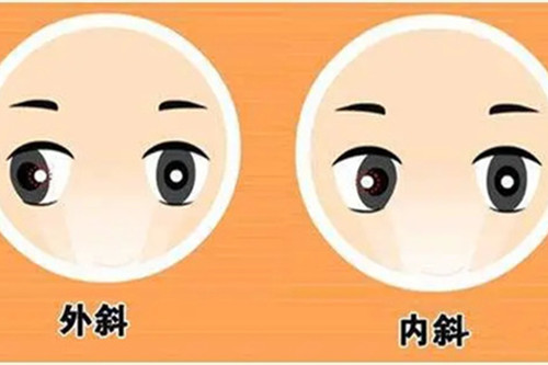 先天性斜视遗传可能性大吗?推荐治疗方式都有哪些?