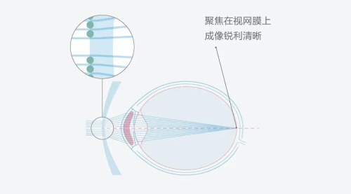 依视路星趣控离焦镜片的矫正视力的原理