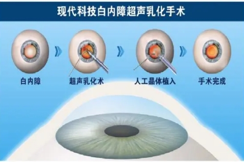 白内障超声乳化吸出术步骤图