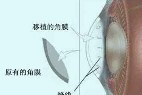 角膜更换卡通示意图
