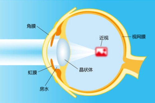 近视眼是怎么回事
