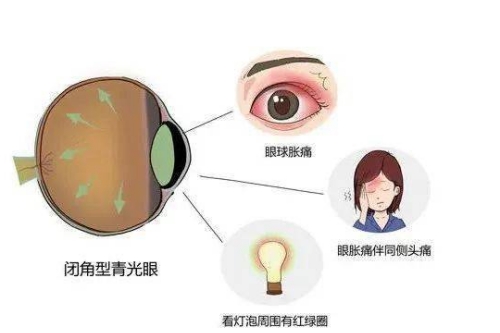 青光眼的症状