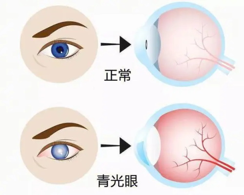青光眼和正常眼睛的不同