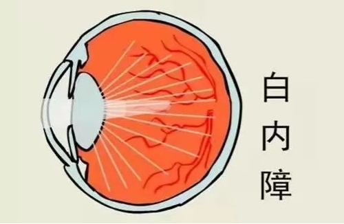 什么是白内障