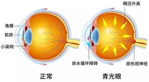 青光眼和正常眼睛对比