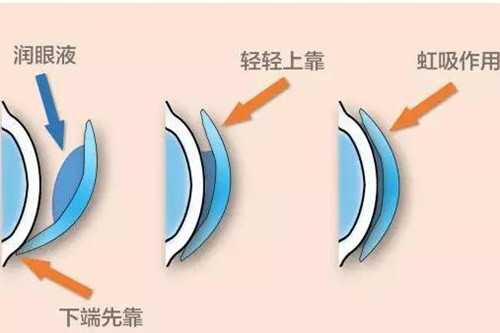 角膜塑形镜佩戴过程示意图
