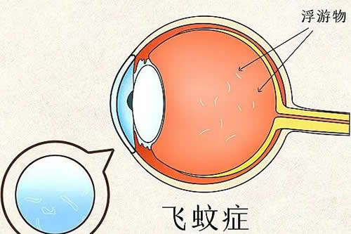 飞蚊症卡通示意图