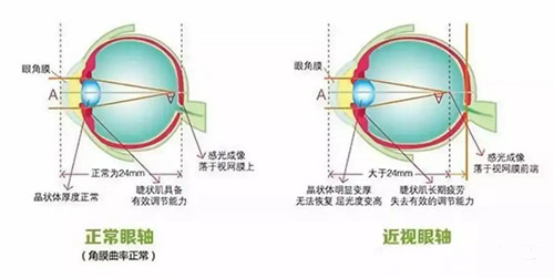 近视眼和正常眼睛区别展示
