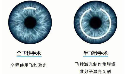 飞秒手术治疗近视眼介绍图