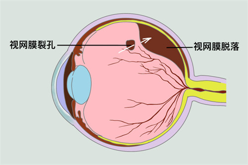 角膜移植是人工角膜吗?配型要求及注意事项有哪些?
