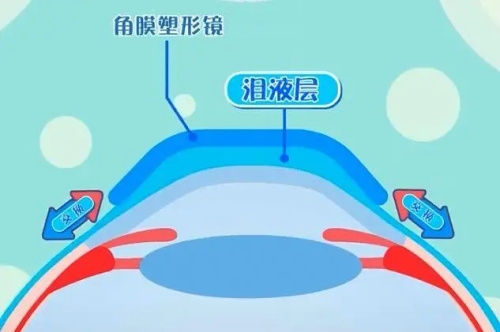 普诺瞳ok镜属于什么档次?从材质、优缺点、不同系列价格综合查询