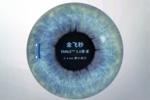 全飞秒手术大解析!具体收费+术前准备+过程解析+术后注意事项各方面都有!