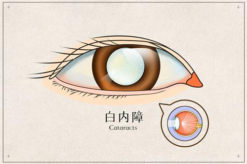 问答篇:单眼白内障该不该做手术?会影响好的眼睛吗?单眼白内障手术费多少钱?