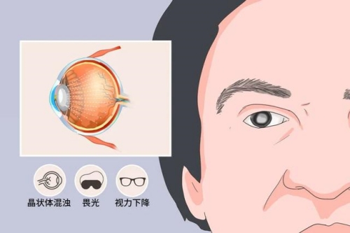 白内装症状卡通图