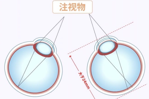 近视眼注视物展示图