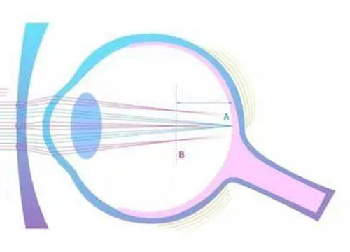 离焦镜片成像示意图