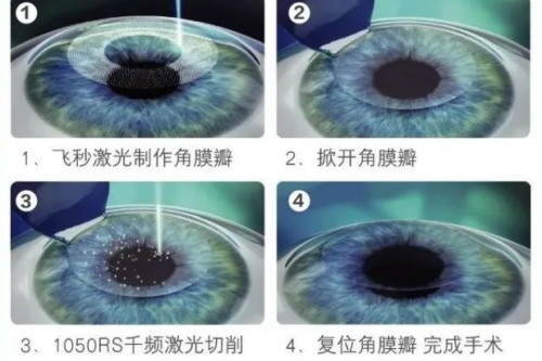 千频优视飞秒手术步骤图