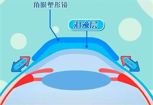 角膜塑形镜佩戴位置卡通图
