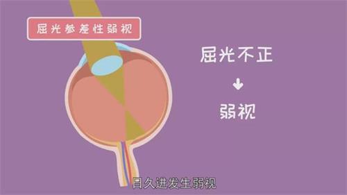 弱视症状示意图