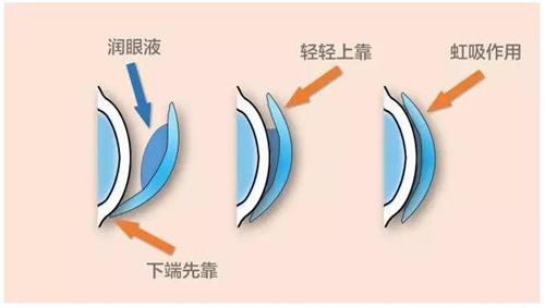 角膜塑形镜佩戴方法示意图
