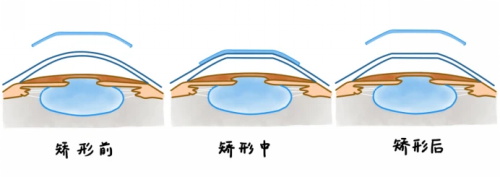 角膜塑形镜矫正前后