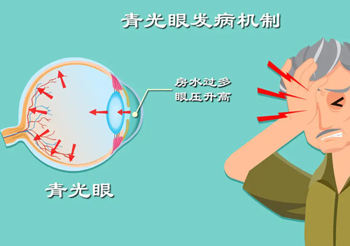 青光眼发病机制卡通示意图