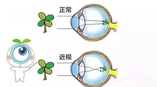 近视眼成像示意图