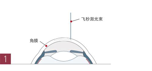 飞秒近视眼手术示意图