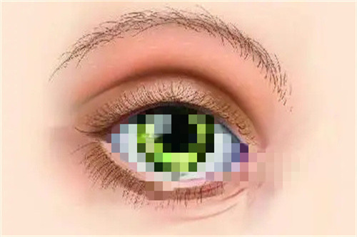 青光眼卡通图