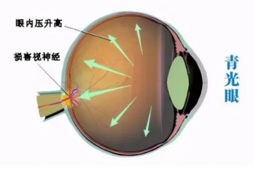青光眼的形成原因