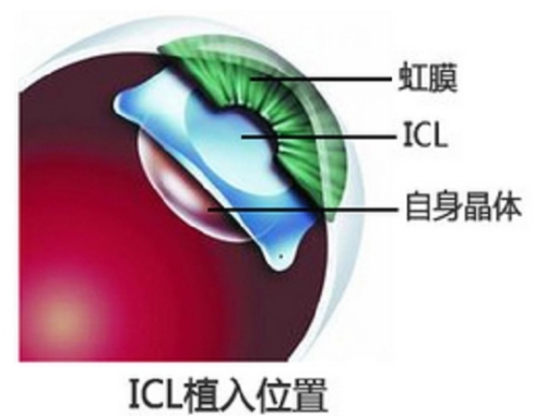  ICL晶体植入概念图