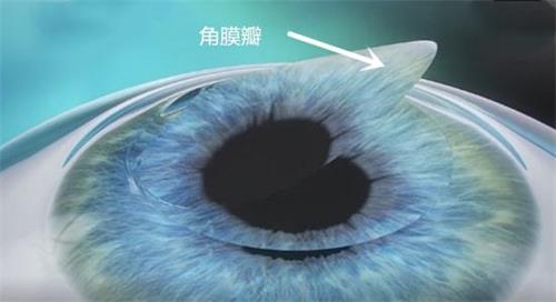飞秒手术的手术部位