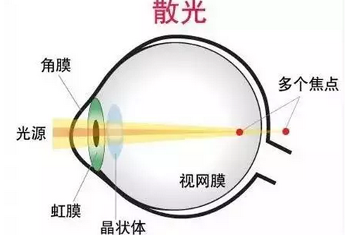 有关散光的问答:散光可以矫正过来吗?近视眼散光手术成功概率高吗?