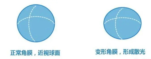 散光眼和正常眼示意图