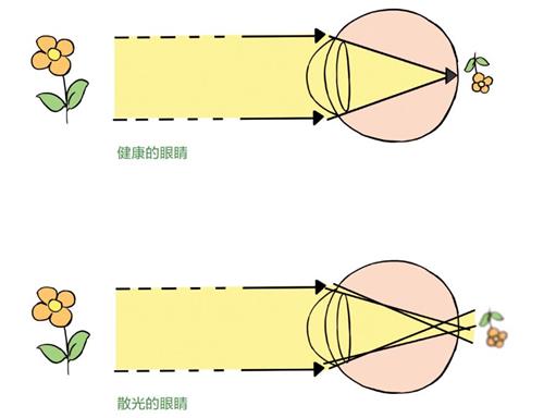 散光眼表现示意图