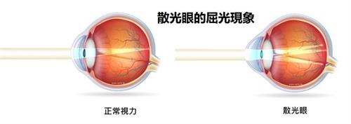 散光眼屈光现象
