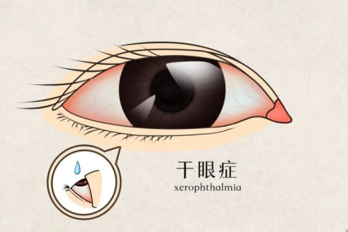 干眼症如何治疗