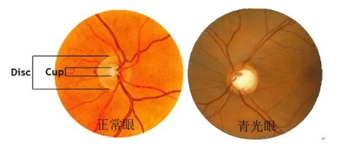 青光眼和正常眼睛