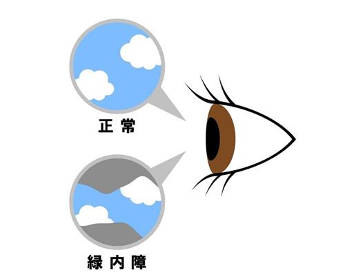 青光眼的视力范围