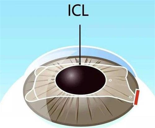 icl晶体的示意图