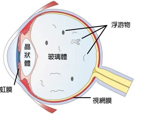巩膜加固手术眼球示意图